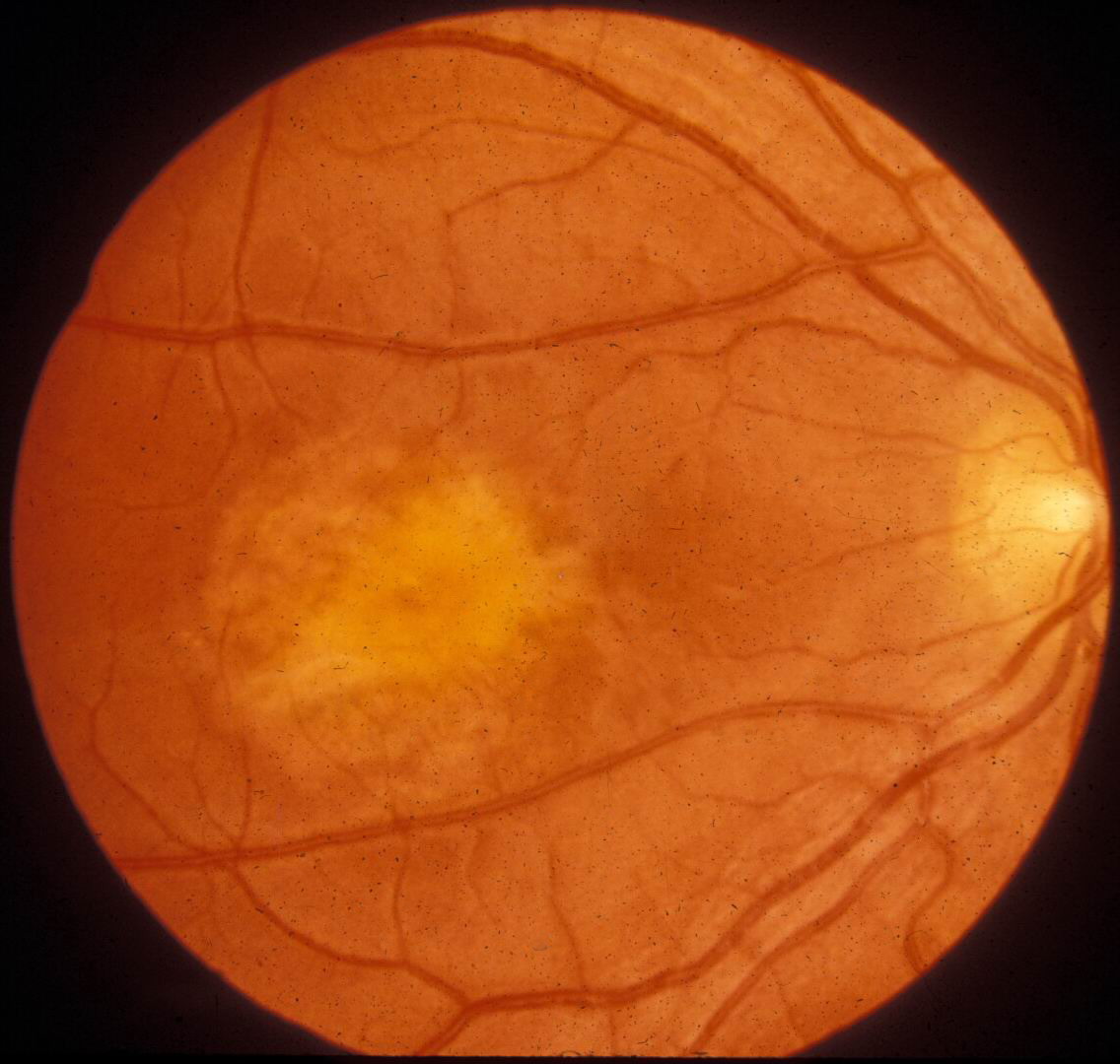 Macular Dystrophy Vitelliform 2 Hereditary Ocular Diseases